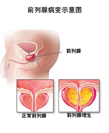 前列腺病变示意图